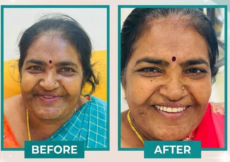 Smile Transformation