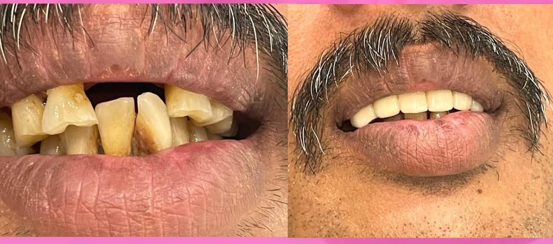 Gum Contouring