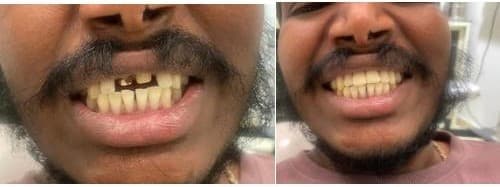 Dental Bridges