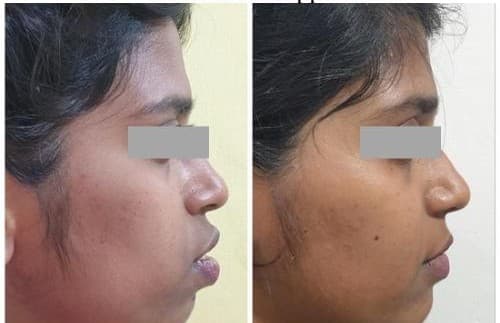 Smile Correction