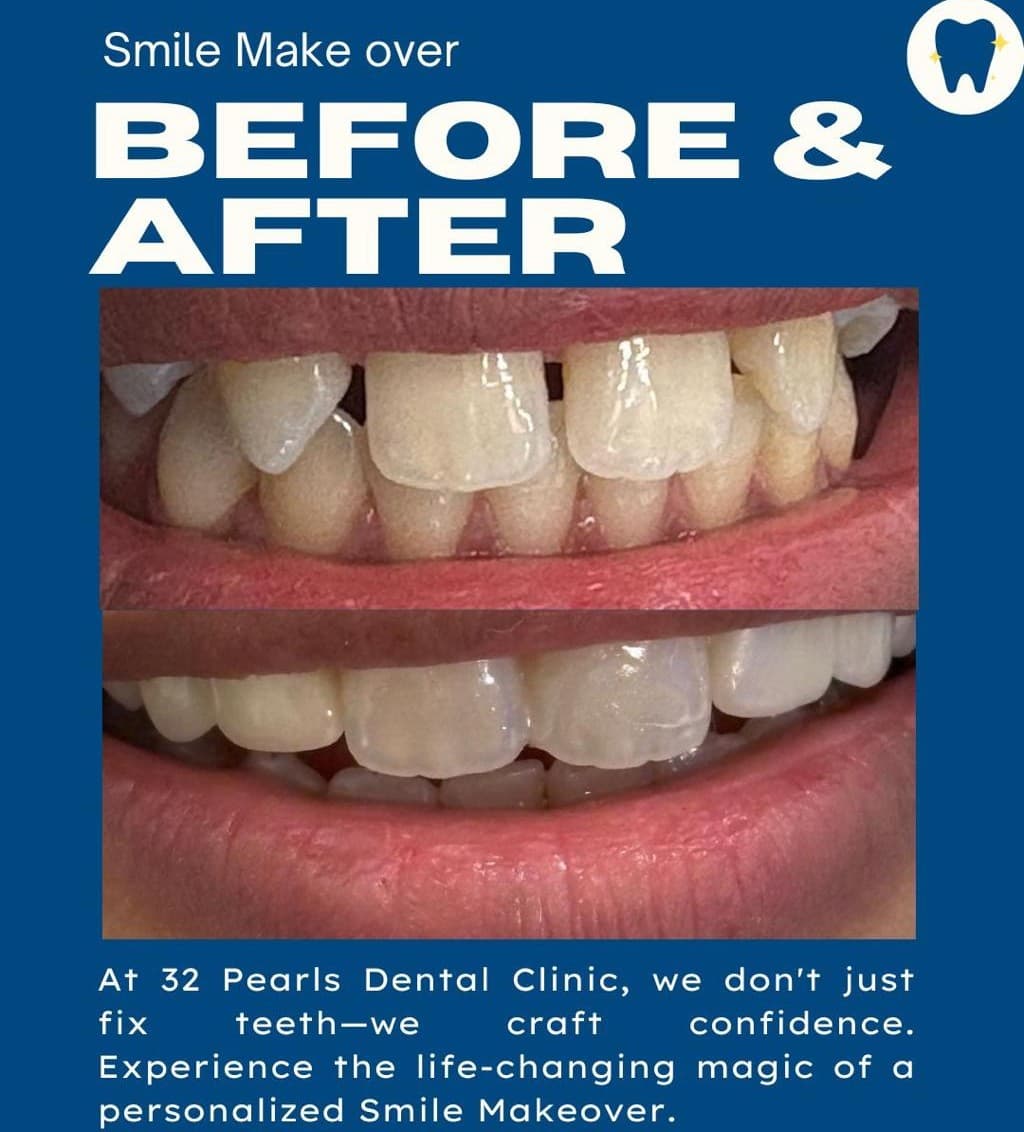 Dental Implants