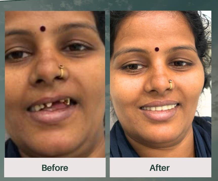 Root Canal Therapy