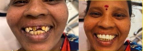 Full Mouth Rehabilitation